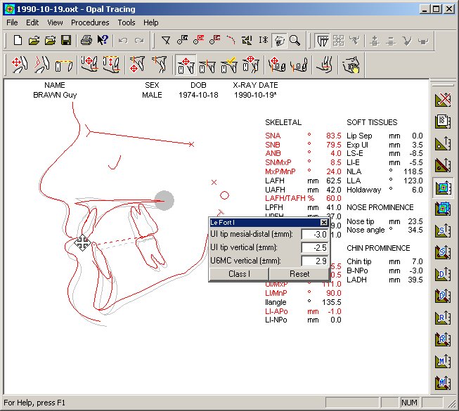 opaltrc-left-facing-surg.jpg