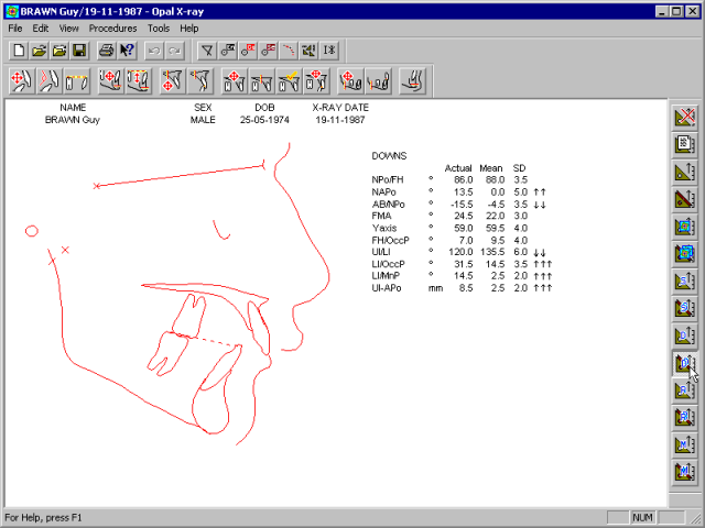 xray-analysis-downs-means.gif