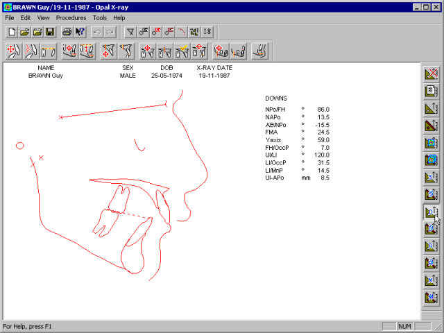 xray-analysis-downs.gif