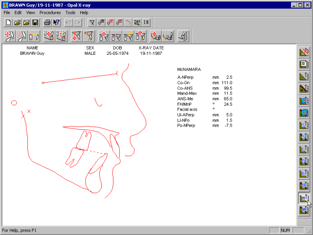 xray-analysis-mcnamara.gif