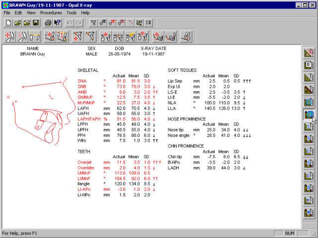 xray-analysis-opal-means.gif