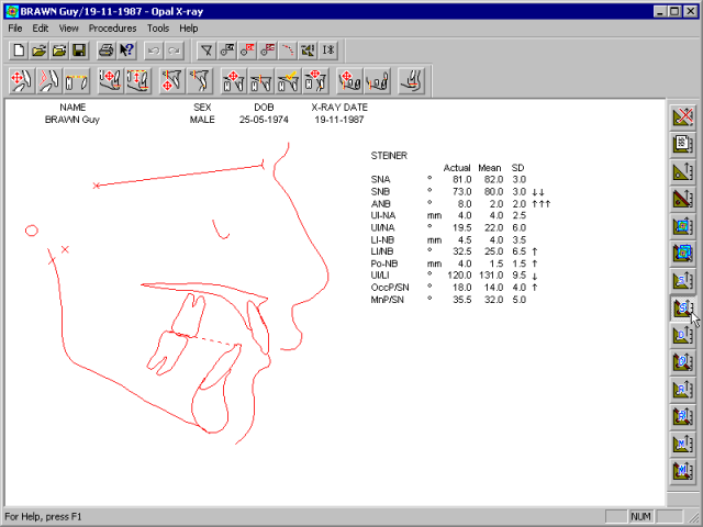 xray-analysis-steiner-means.gif